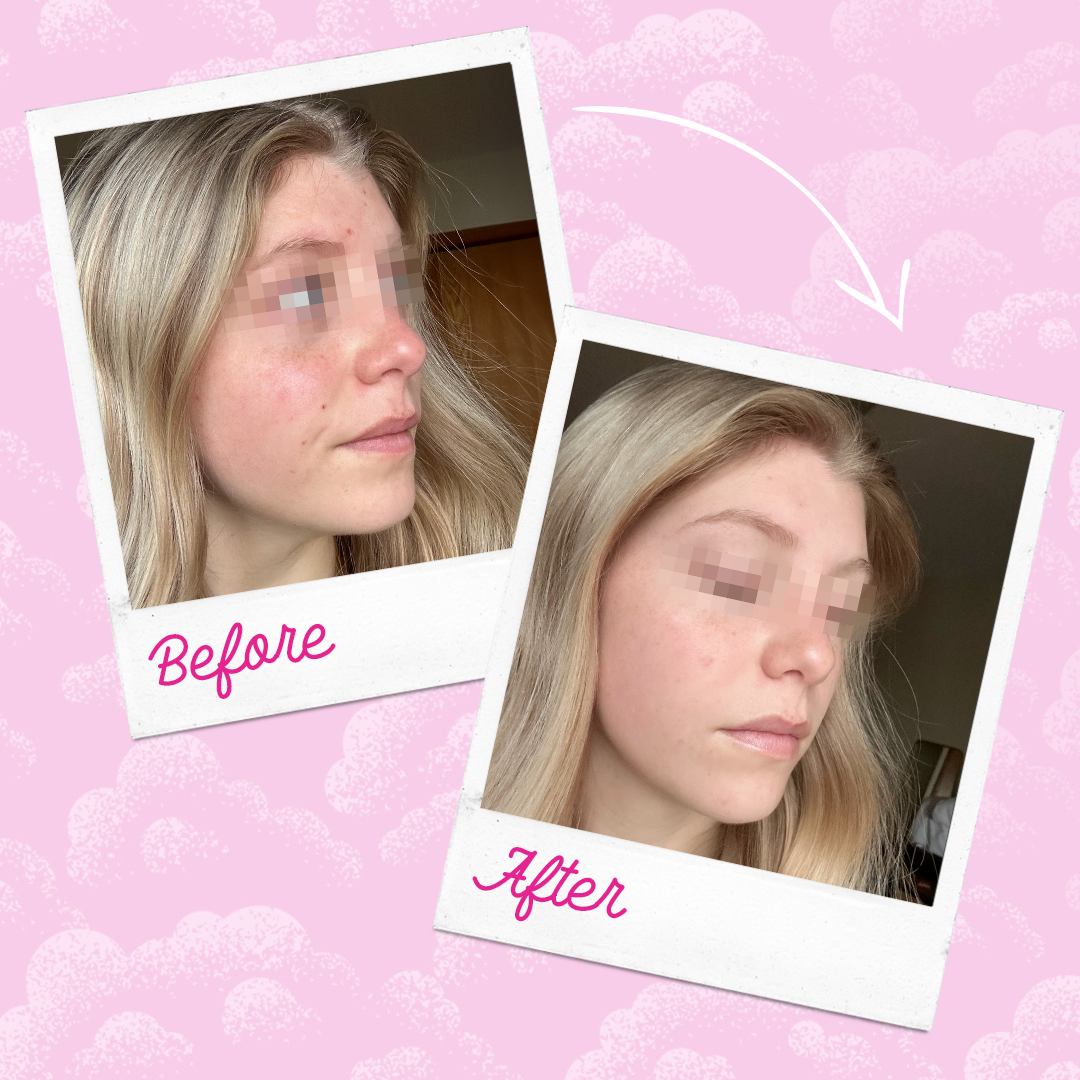 Silver Infused Make Up Eraser PRO - Acne Prone Skin